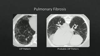 HRCT Pneumoconiosis [upl. by Riba189]