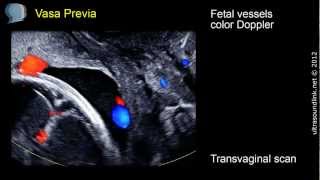 Vasa Previa  ultrasound diagnosis [upl. by Harmonia]