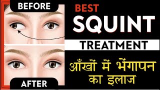 Best Squint treatment  Causes Symptoms amp Treatment of Squint  strabismus  भेंगापन का सरल इलाज [upl. by Joey993]