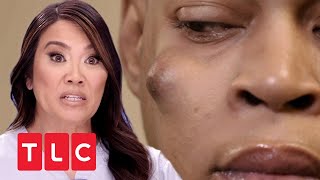 Riesenknubbel im Gesicht  Dr Pimple Popper  TLC Deutschland [upl. by Yren]