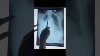 Chest XrayIatrogenic Hydropneumothorax [upl. by Enyawed]