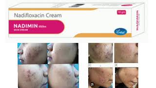 NADIMIN SAIN CREAM Nadifloxacin Cream [upl. by Nevar]