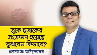 Skin fungal infection treatment  Skin fungal acne  Skin care bangla  Health Tips Bangla [upl. by Malinda]