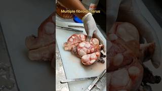 Multiple fibroid uterus specimen [upl. by Airotkciv]