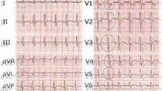 elettrocardiogrammasecondapartewmv [upl. by Gentille]