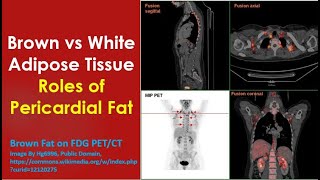 Brown vs White Adipose Tissue Roles of Pericardial Fat [upl. by Ordnassela]