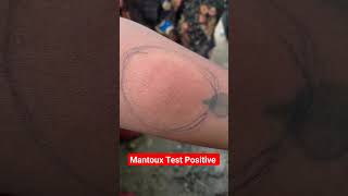 Mantoux Test Result Positive shortsyoutubeshorts virulshorts [upl. by Bergstrom]