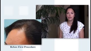 Female Hairline Restoration  Patient Update with Dr Dan McGrath [upl. by Emmeline]