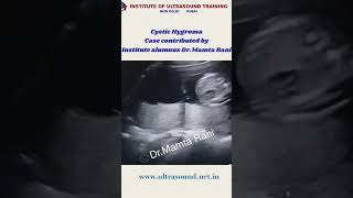 Cystic hygromaFetal ultrasound ultrasound drrandhawainstitute obgyn medicalvideos [upl. by Atikkin86]