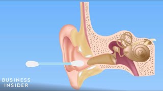 Forget QTips — Here’s How You Should Be Cleaning Your Ears [upl. by Vandyke]