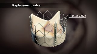 TAVI Transcatheter Aortic Valve Implantation [upl. by Aissert]