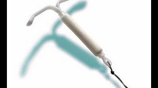 Mirena IUD side effects [upl. by Glenda533]