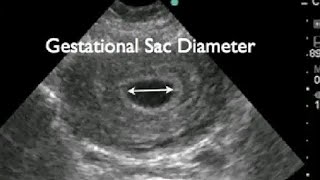 Early pregnancy gestational sac measurement [upl. by Assiar232]