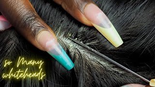 ASMR ATTENTIVE Scalp NITPICKING so many 😴 WHITEHEADS  super zoomed [upl. by Moreland]