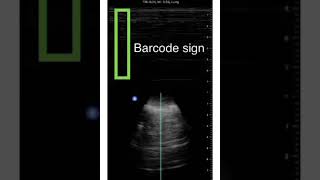 Absent pleural sliding in right lung in patient with decortication [upl. by Eecram91]