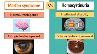 Marfan Syndrome Vs Homocystinuria Mnemonics And High Yield Points For For NEET PG  FMGE [upl. by Jardena]