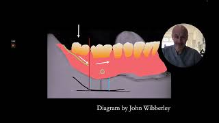 Leave off the second molars for complete dentures [upl. by Lottie104]