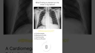 Chest Xray Buzz 21 radiologychannel007 [upl. by Maris158]