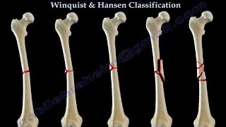 Fractures Of The Femur Shaft Winquist amp Hansen  Everything You Need To Know  Dr Nabil Ebraheim [upl. by Keil581]