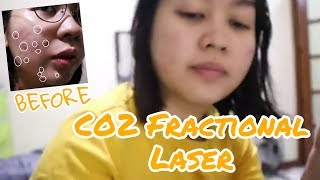 CO2 Fractional Laser for Acne Prone Skin  Betina Jareno [upl. by Adnerad]