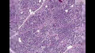 Histopathology Pancreas   Adenocarcinoma [upl. by Gleda]