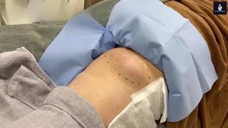 Huge Creamy Epidermal Cyst Incision and Drainage [upl. by Leehar]