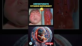 Neural tube defect due to folic acid deficiency  Vitamin deficiency in Pregnancy trending vitamin [upl. by Hyacinthia]