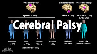 Cerebral Palsy Animation [upl. by Idok999]