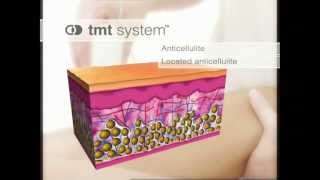 TMT System  mesoestetic Canada [upl. by Bouldon]