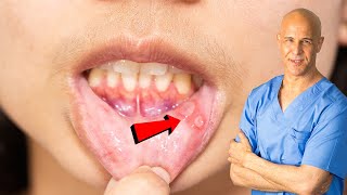 How I Quickly Healed My Canker Sore  Dr Mandell [upl. by Diamante]