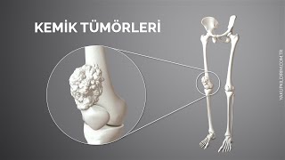 Kemik Tümörleri  Prof Dr Yakup YILDIRIM [upl. by Eicyaj]