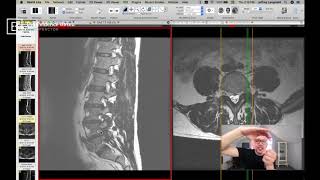 Clinical Series How to See a Pinched Nerve Foraminal Stenosis on MRI [upl. by Gemina]