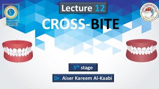 Crossbite Lec12 stage5 [upl. by Lazor40]