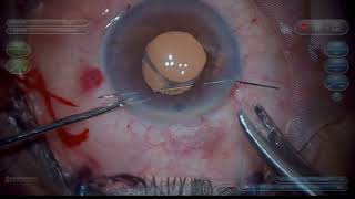 Pupilloplasty Dr Nidhi Patwardhan Live pupilloplasty surgery [upl. by Oinegue374]