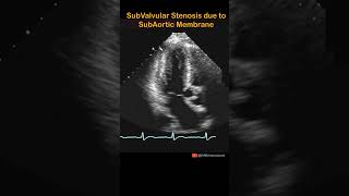 Subvalvular Aortic Stenosis cardiology echocardiography shorts echocardiogram aorticstenosis [upl. by Zanas355]