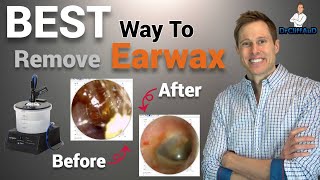 The BEST Way to Professionally Remove Earwax  Earigator Cerumen Irrigation [upl. by Oab166]