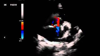 Comunicão Interatrial em Cão com Insuficiência Mitral [upl. by Eanar]