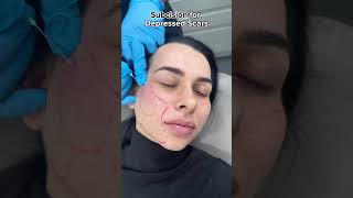 Subcision for ACNE SCARRING  Doctor Treatment [upl. by Addi]