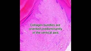 Histopathology of Acral Digital Fibrokeratoma pathology dermatopathology dermpath pathologist [upl. by Conley987]