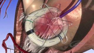 Mitral Heart Valve Ring  Medical amp Scientific Video Production [upl. by Bergwall]