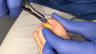 Usuwanie wrastającego fragmentu paznokcia  Ingrown toenail removal [upl. by Ellecram163]