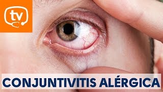 Claves sobre la conjuntivitis alérgica [upl. by Rotciv]