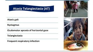 Ataxia Telangiectasia  Spot Diagnosis  12  Pediatrics [upl. by Direj264]