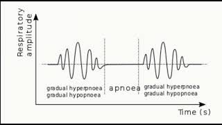 Cheyne stokes breathing in a patient with heart failure [upl. by Bell846]