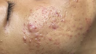 ACNE TREATMENT VU QUYNH MI  Perennial Blackheads On Boy Face 2024FULL [upl. by Odysseus337]