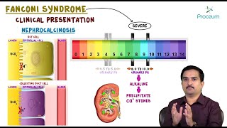 Fanconi syndrome  Etiology Clinical Features Pathology Diagnosis and Treatment usmle pathology [upl. by Winser]