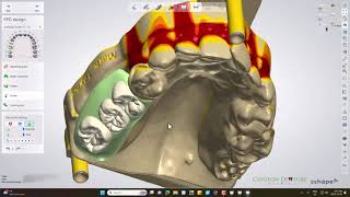 Cast Partial Denture Digital Design [upl. by Fleeman365]