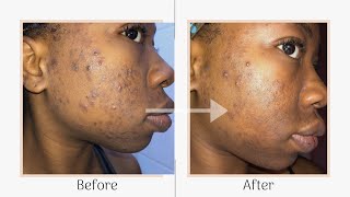 Skincare Series  Mandelic Acid Peel Two Week Progress amp Peeling Progress pictures included [upl. by Lemert]