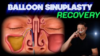 How Long Does It Take To Recover From Balloon Sinuplasty Surgery [upl. by Chappie]