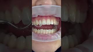 Porcelain Laminate Veneers [upl. by Sal69]